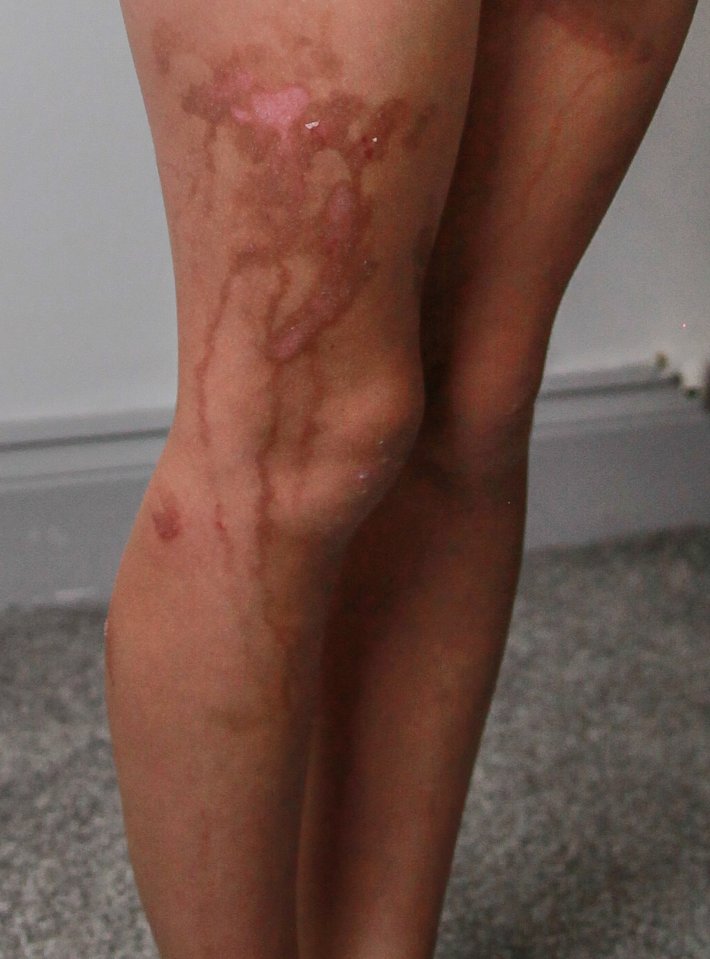 Olivia Nickles suffered bad burns from suncream on holiday in Mexico with her mum Louise