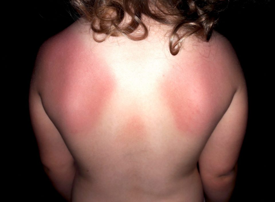 Amber Ross, 3, was badly burnt across her back after nursery staff did not apply sunscreen