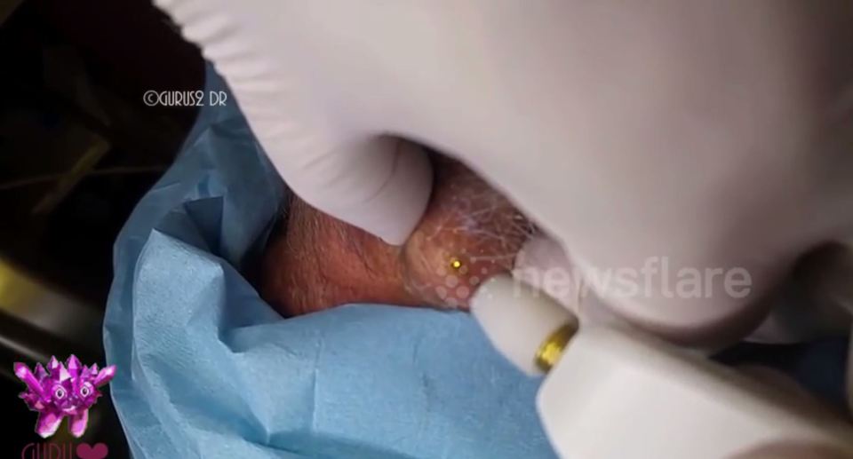 Dr Guru has uploaded a new video which shows them start by making a hole in a man's cyst by using a laser