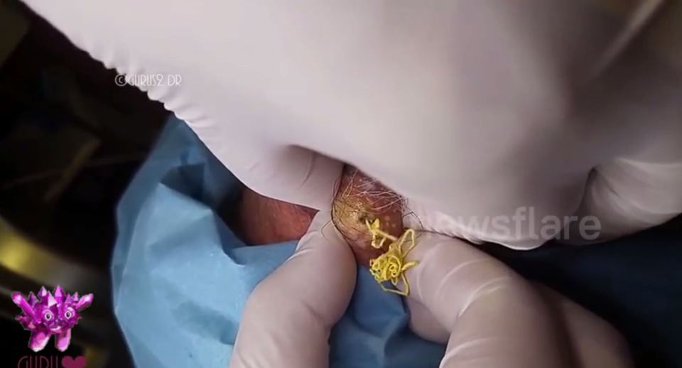 Once the medical professional has made a hole that's large enough they start to squeeze the pus out