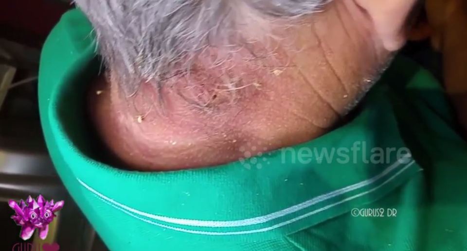 But after a few minutes of squeezing, Dr Guru seemed to have removed it all