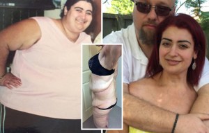 Obese ‘human airbag’ with maggots in her leg says wall of flab saved her life in car smash
