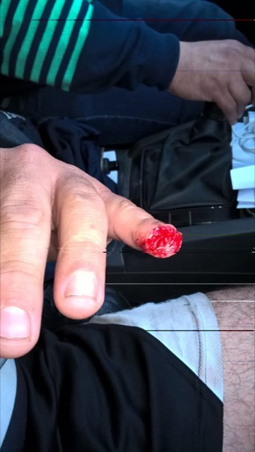 What is left Daniel Contreras' finger after an opponent brutally fit his finger off in a ruck