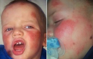 Toddler needed to be lathered in cream every hour thanks to eczema so bad he looked beaten up