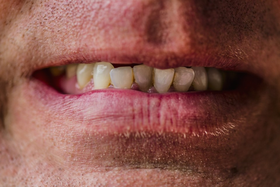 Too much tea can course teeth to change to an ‘off’ colour 