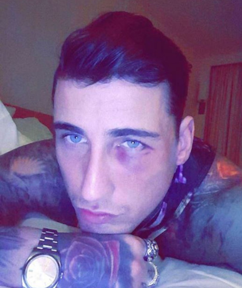 The Irish model was reportedly left needing six stitches after the vicious spat
