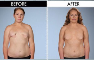 Mum-of-two left with 'crab claw boobs' after botched breast surgery to remove infected implants