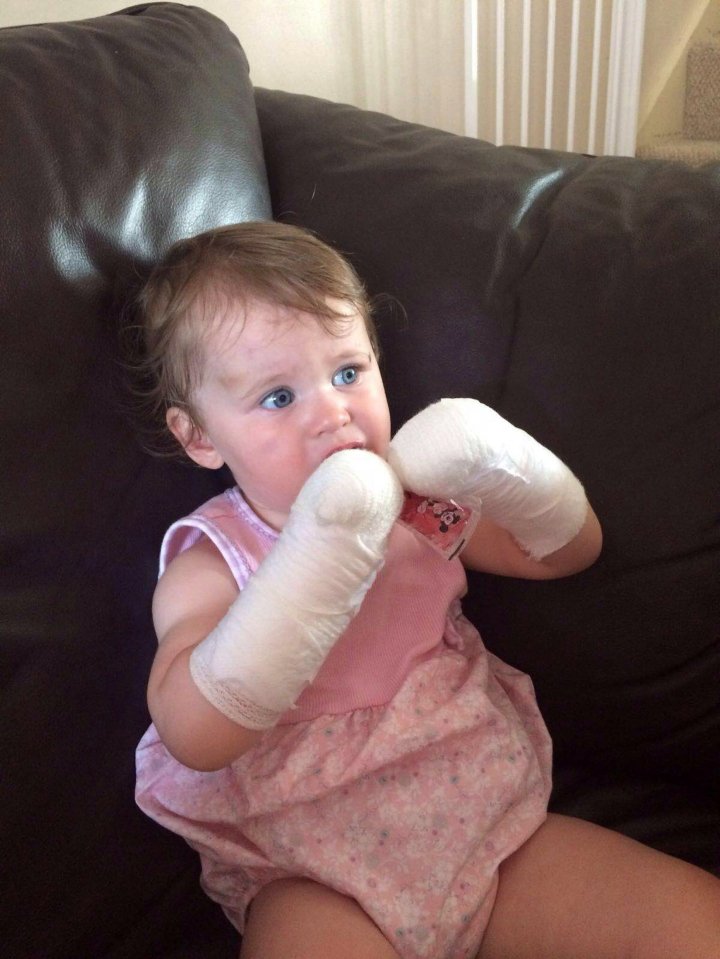 Eva was left with bandaged hands after the horror injury