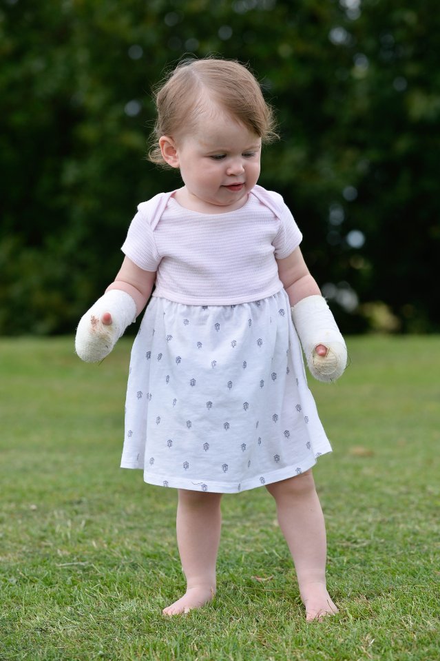 Eva is due back at hospital soon to have her bandages redressed