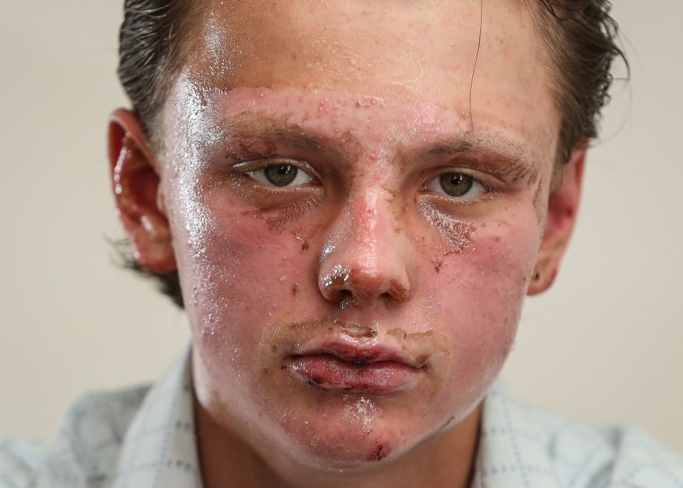 Kyle Round suffered horrific injuries in the aerosol can accident