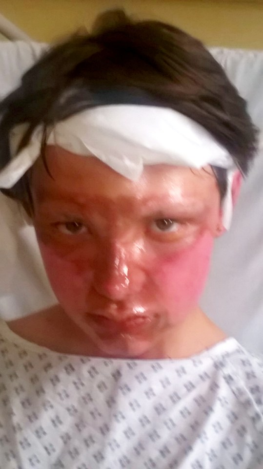 He must also return to hospital once a week and his wounds are continuing to weep