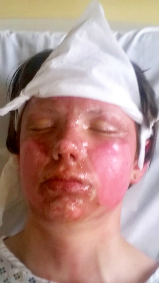 Kyles parents must regularly wash him down using sterilised wadding and gloves