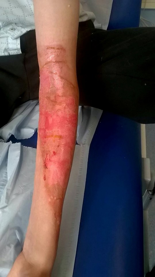 He must now avoid direct sunlight for two years in order for the skin to heal