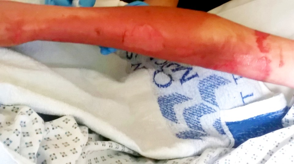 Kyle's arm pictured after he was turned into a human fireball