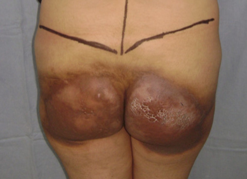 Dr Mendieta has seen scores of women with botched bottom surgery, desperate for it to be corrected