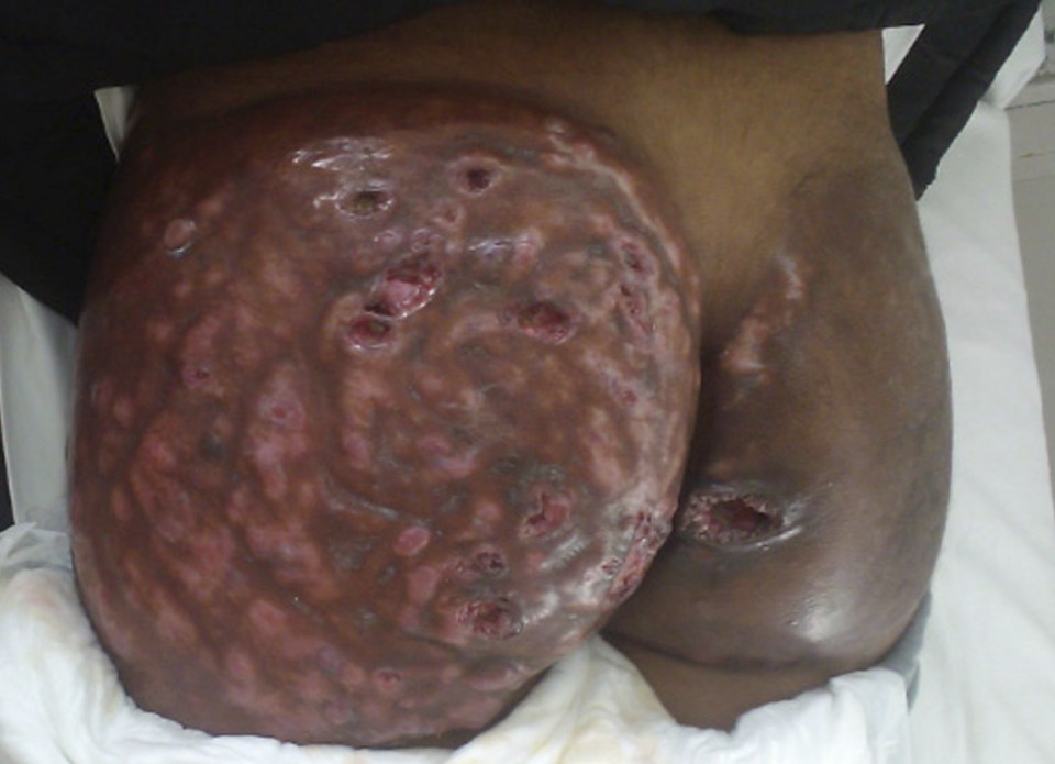 It can be ten years later that people get infections, hardness, pain and disfigurement from backstreet buttock injections