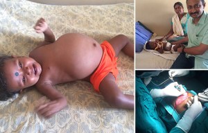 Parasitic twin growing INSIDE tot had stopped her eating and drinking and was crushing her organs