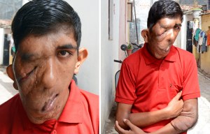 Teen with rare skin condition which has caused his face to sag is too scared to leave his village