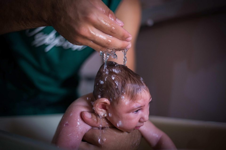 This four-month old baby was born in Brazil with microcephaly