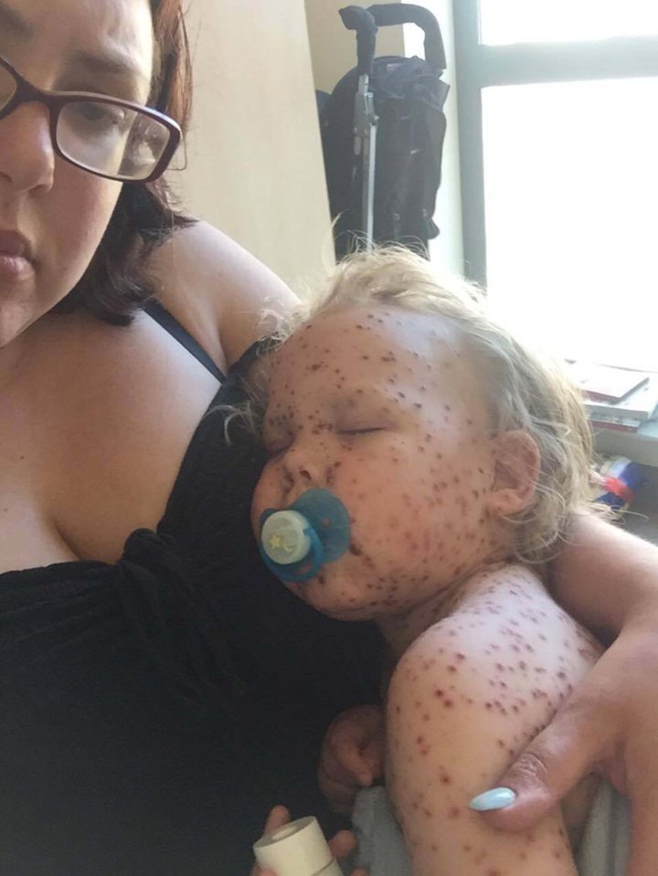 Jasper was completely covered in the pox