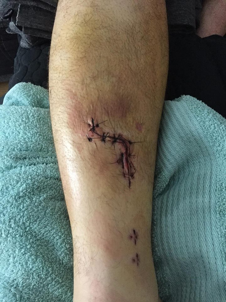 Raymond had to have a seven-hour operation to repair his leg 