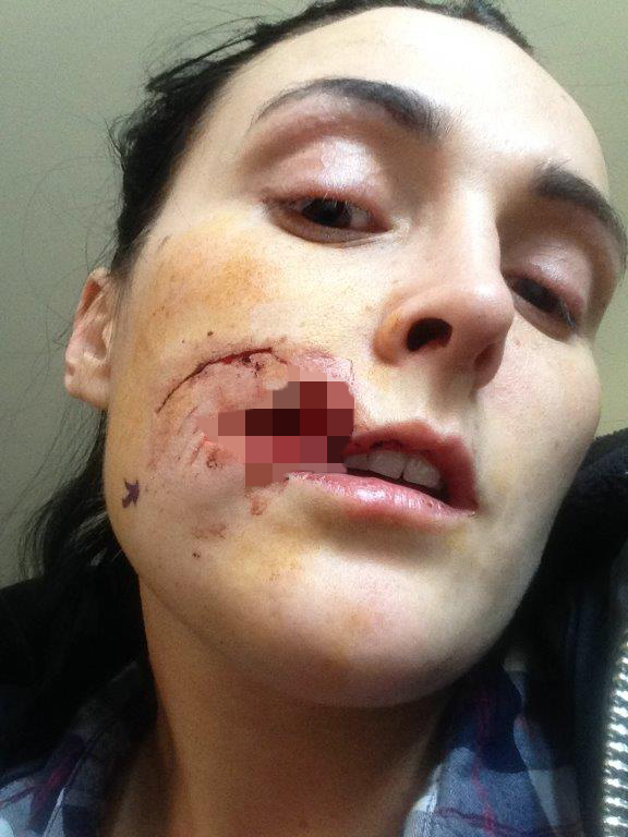 Kate Nield face bitten off