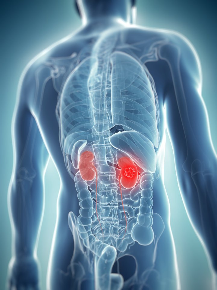 Kidney cancer
