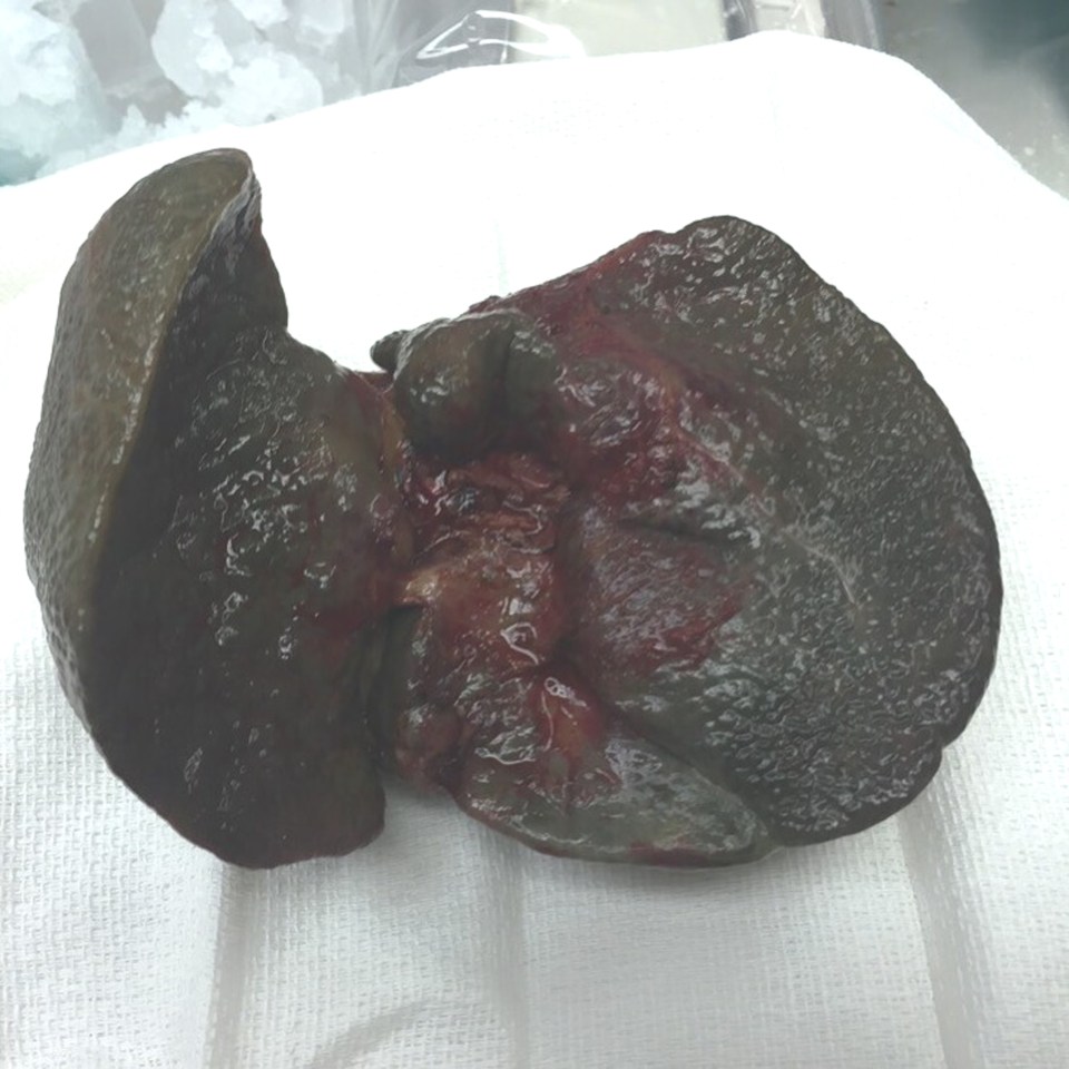 Allie's diseased liver was black and resembled a lump of coal, when it was removed from her tiny body in July last year