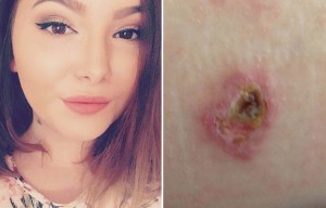 Student struck by rare meningitis strain that normally infects babies urges all teens to pay for…