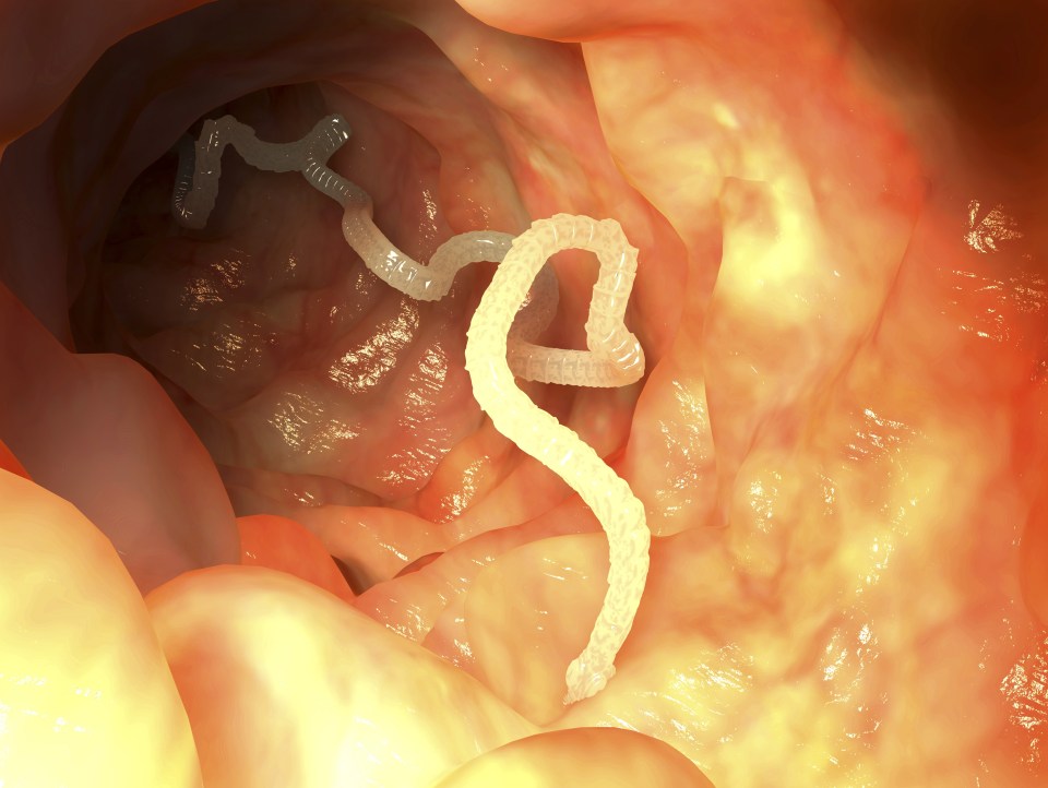 Tapeworms typically infect a persons liver or lungs, but in rare cases cysts containing their eggs can lodge in the brain. Pictured, what a tapeworm in the intestines looks like