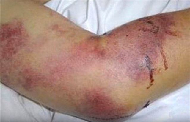 Infected people can experience a bloody rash as a result of internal bleeding beneath the skin