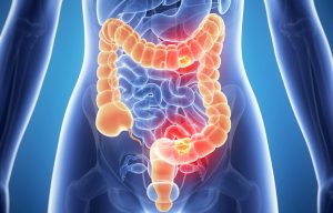 How YOU can prevent cancer in 8 simple steps - according to science