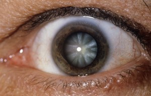 NHS patients waiting up to 15 months for life-changing cataract operations