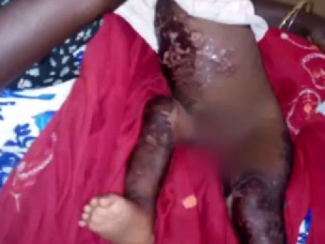 Survivors spoke of horrific injuries, including burns, sores and breathing problems 