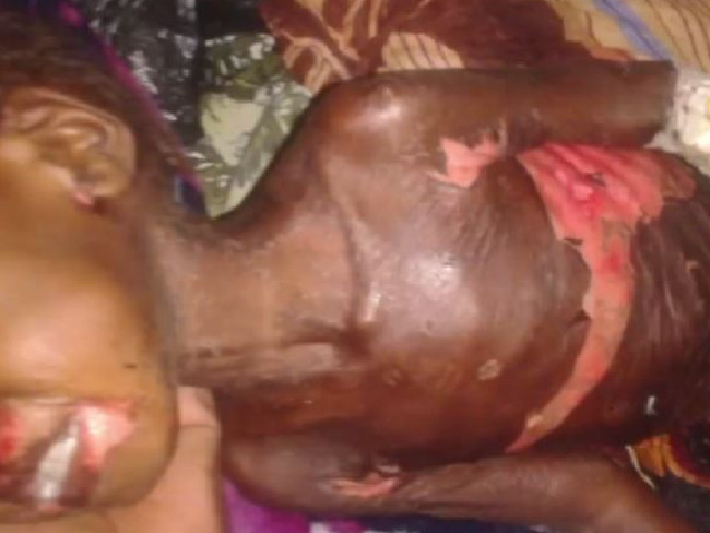 Victims suffered horrific chemical burns which caused their skin to peel off