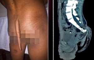 Lad, 18, finally has seven-inch TAIL removed after spending his life being worshipped as a monkey god in India
