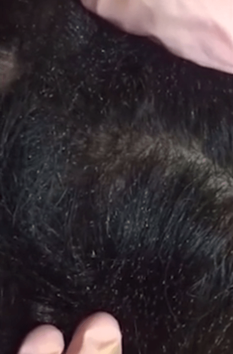 lice-1