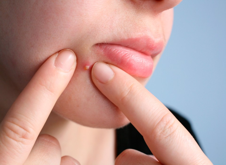 Everyone loves a pimple-popping session but be careful to look for infection 