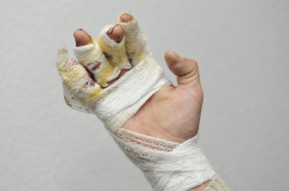 fingers severed by clown