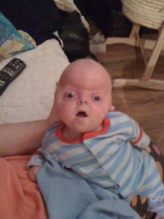 Inspirational Little Boy With Rare Genetic Disorder Defies The Odds Of Condition
