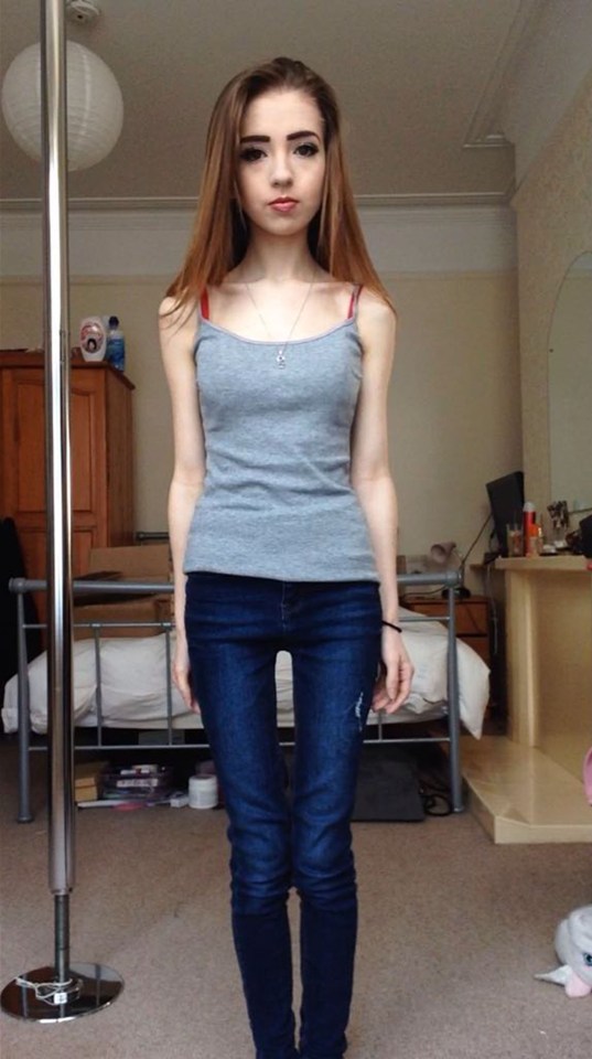 Faye's weight plummeted as she began restricting her diet
