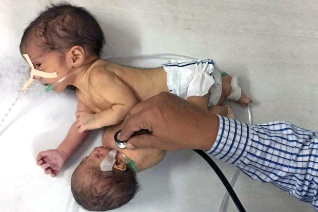 Doctors believe they will be able to remove the parasitic twin from the baby boy, without compromising his condition