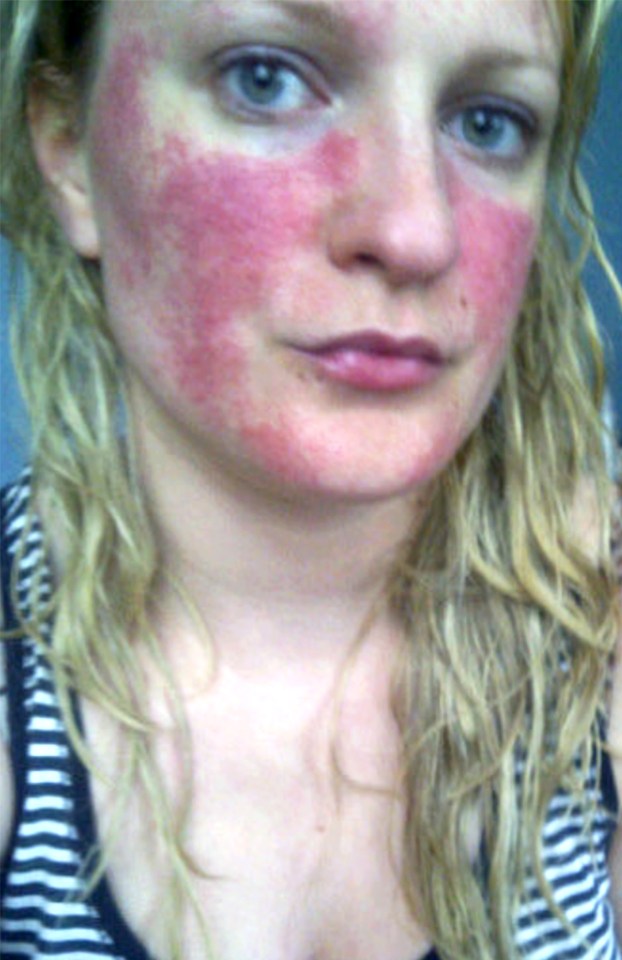 After discovering there is no cure for the condition, the 32-year-old made drastic changes to her lifestyle in a bid to reduce the number of flare up she suffered
