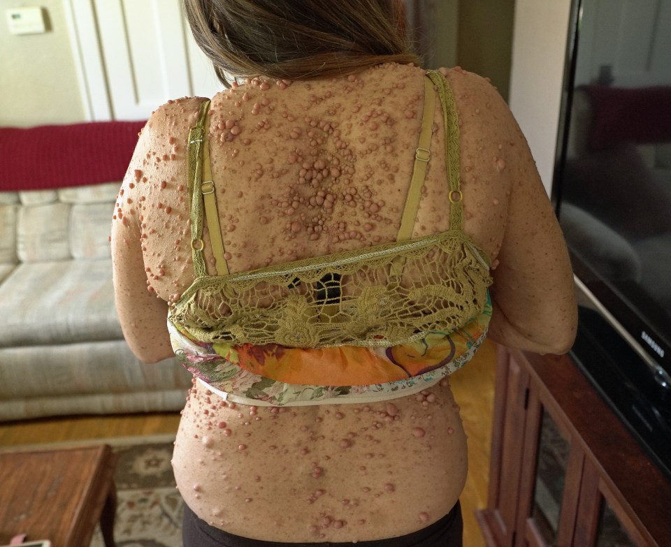 The 44-year-old was diagnosed with neurofibromatosis type 1 when she was just five years old