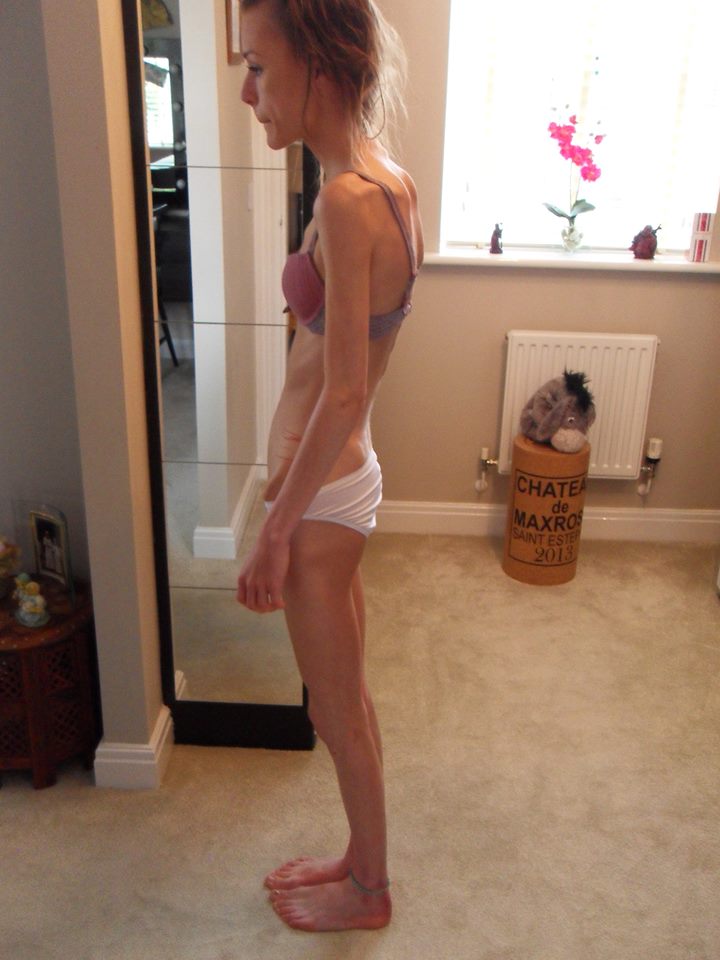 Katy weighed just 5 stone when she was admitted to hospital