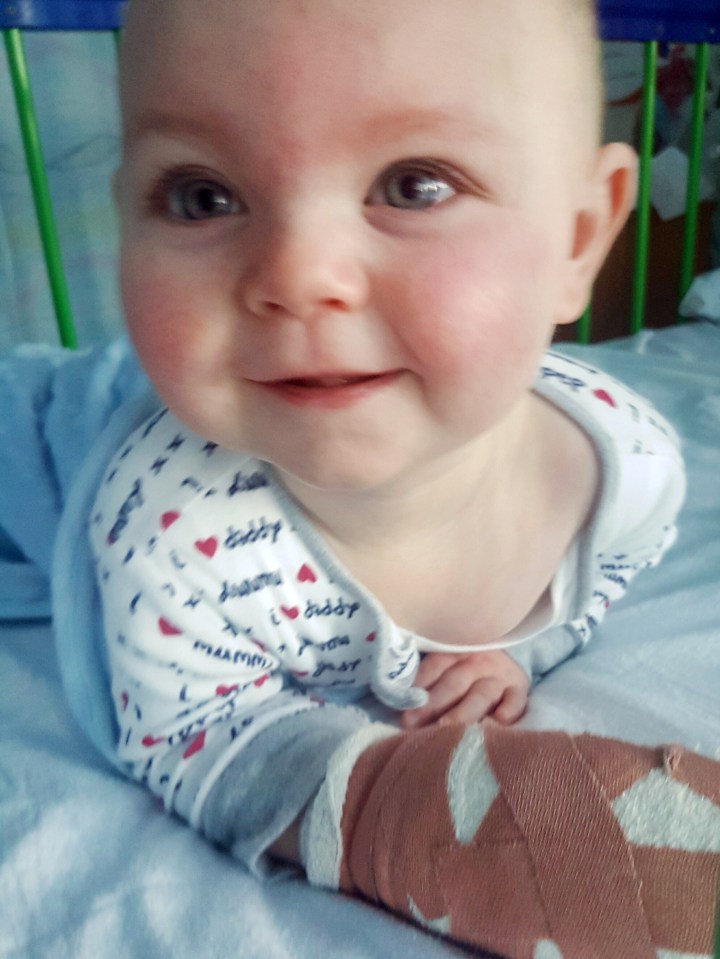 Nine-month-old baby Charlie Davies suffered second degree burns after touching a hot radiator pipe