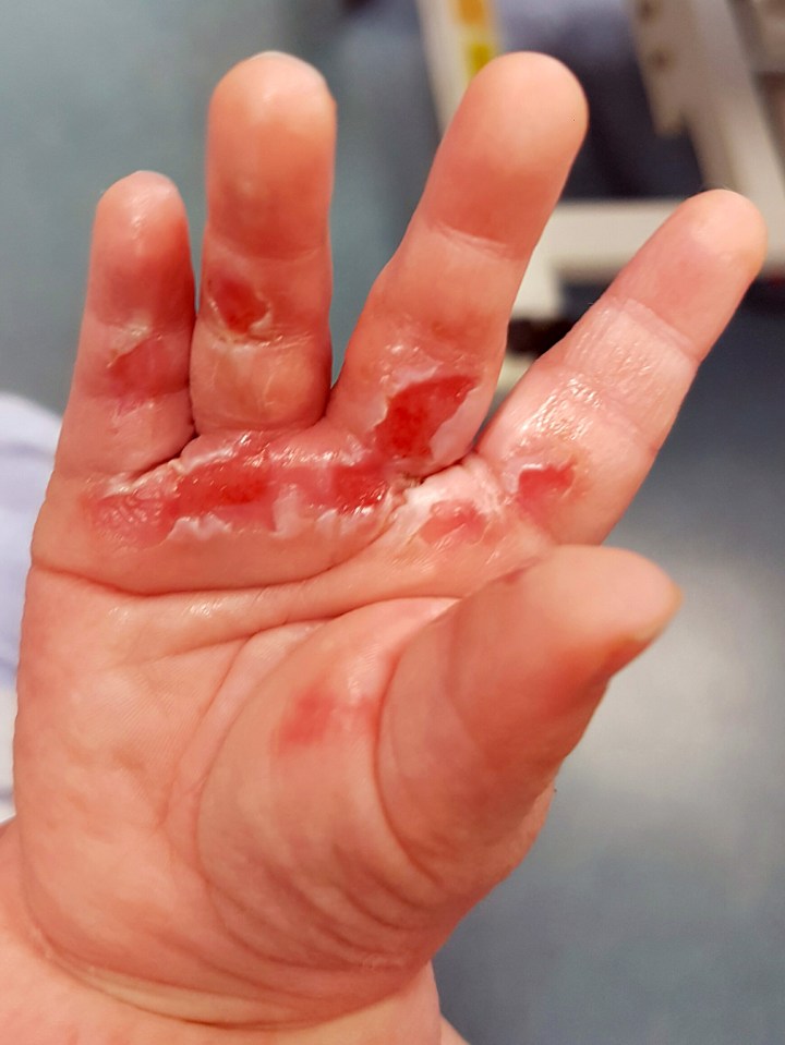 Charlie was taken to hospital in an ambulance where they cleaned up the blisters and bandaged his hand