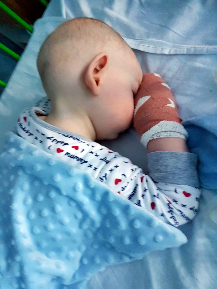Doctors told his mum that if it heals in two weeks he won't have scarring