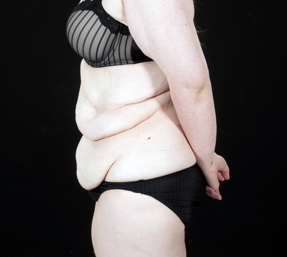 She spent £6,000 having the skin surgically removed in America last year 