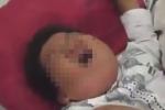 A boy has had the head of his penis severed in a botched circumcision